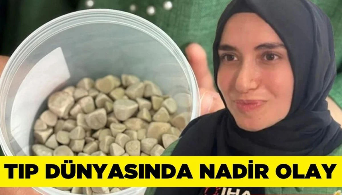 Genç Kadının Vücudundan 287 Adet Taş Çıkarıldı!